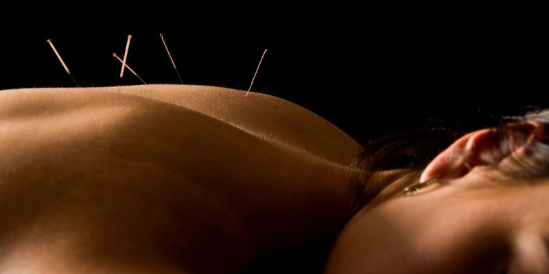 Close-up of acupuncture treatment on a patient's back